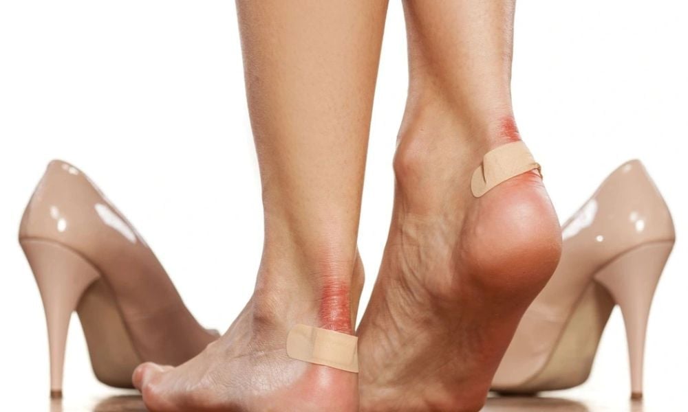 Mụn nước ở chân do đi giày quá chật