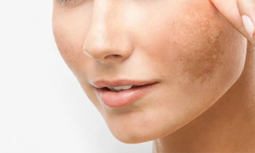 Nám là gì? Nguyên nhân hình thành nám da và biện pháp điều trị