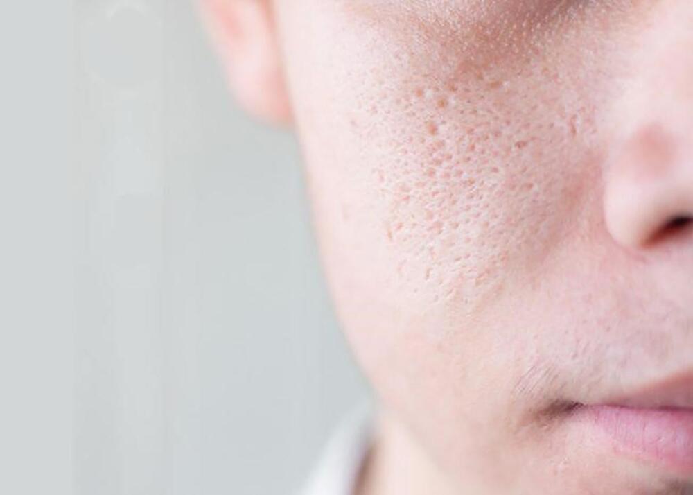 Nặn mụn có thể để lại sẹo vĩnh viễn