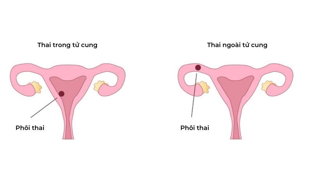 Thai trong tử cung và thai ngoài tử cung 