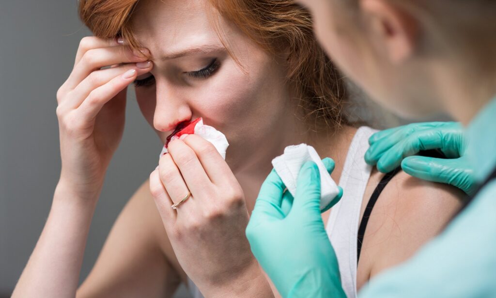 Chảy máu mũi bắt nguồn từ điểm mạch Kisselbach