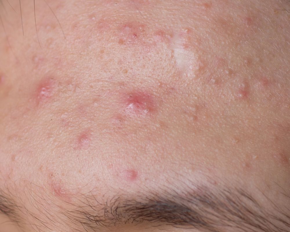 Các nguyên nhân gây mụn phổ biến