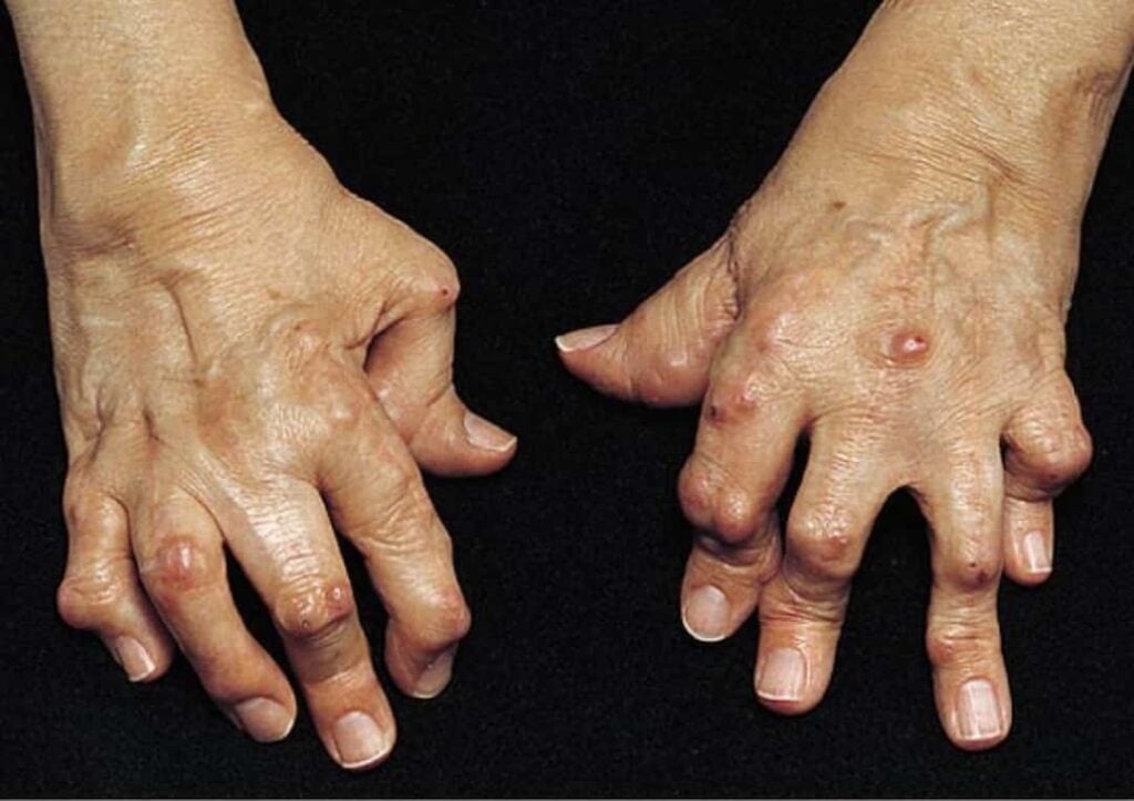 Nguyên nhân gây nên bệnh phong