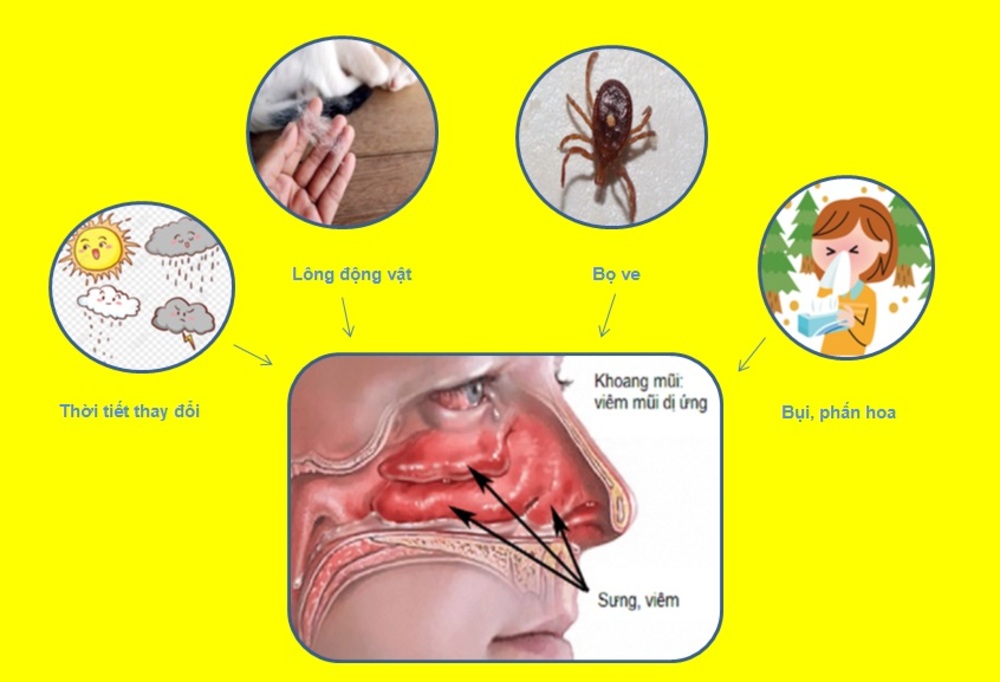 Các nguyên nhân viêm mũi dị ứng
