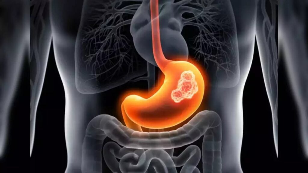 Ung thư dạ dày sẽ gây ra đau dạ dày 