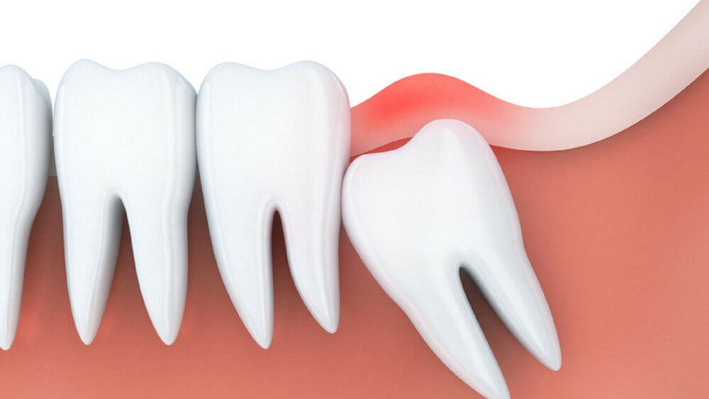 Răng số 8 mọc xô lệch gây sưng đau lợi