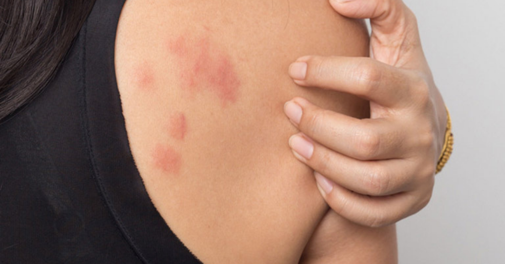 Dấu hiệu da bị nổi mẩn đỏ ngứa