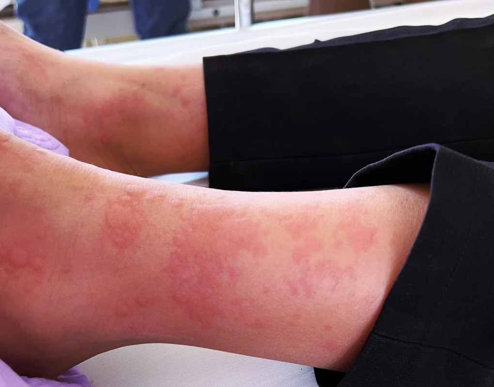 Bị nổi mẩn ngứa khắp người phải làm sao?