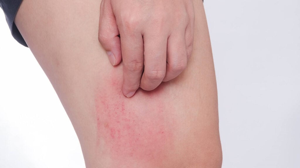 Tình trạng nổi mề đay có 2 loại cấp tính và mãn tính