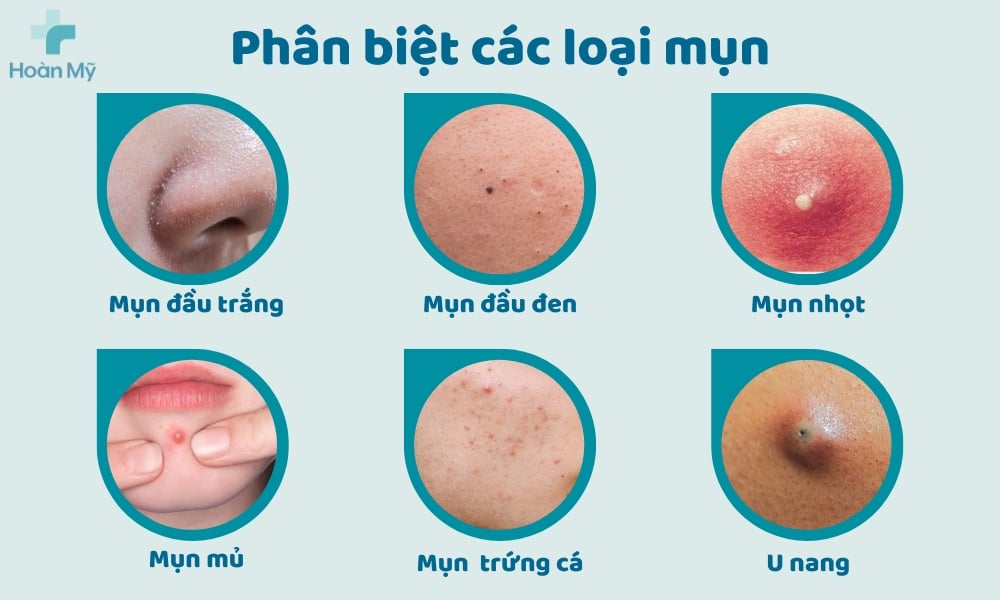 Phân biệt các loại mụn