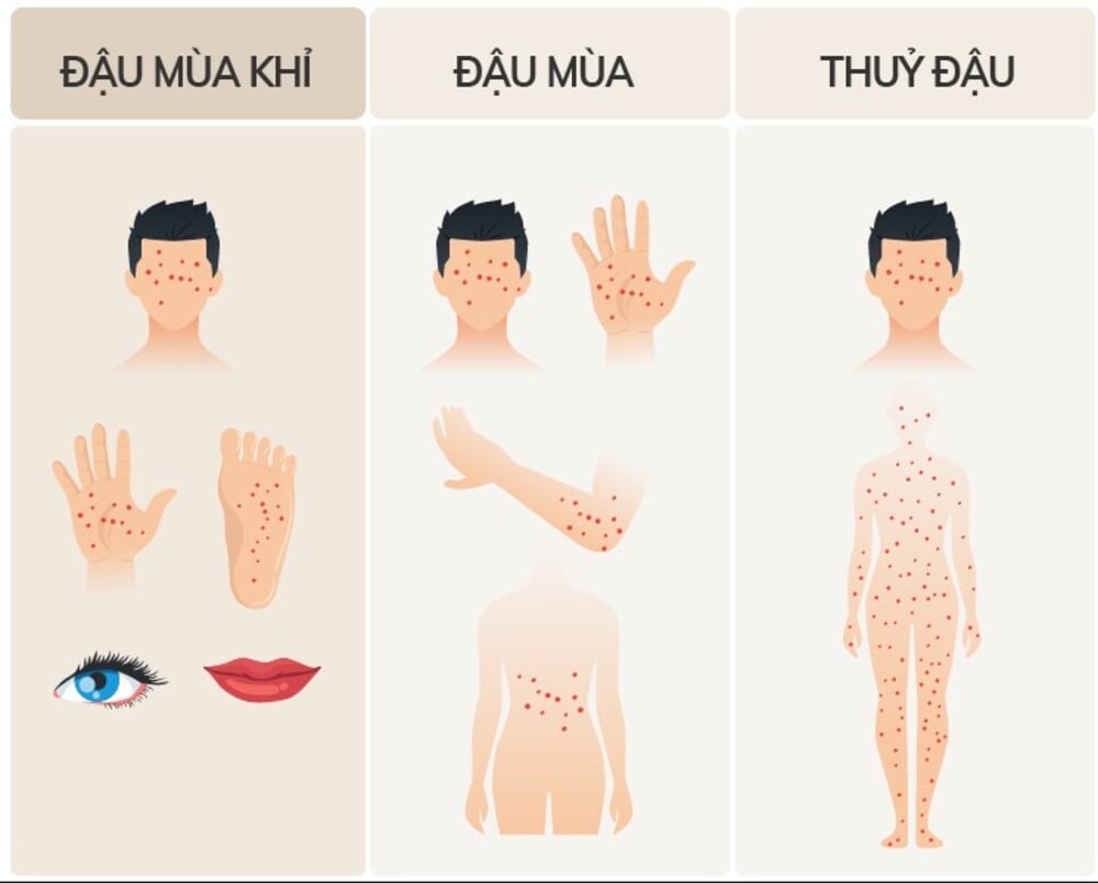 Phân biệt triệu chứng đậu mùa khỉ và thuỷ đậu
