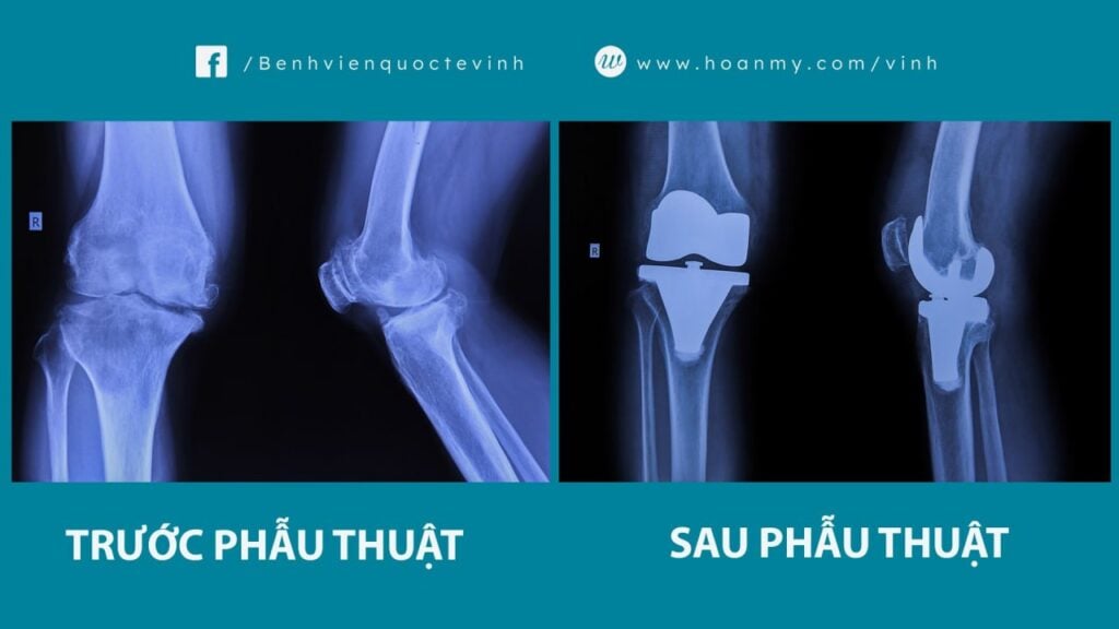 Khôi phục vận động sau phẫu thuật thay khớp gối toàn phần cho người bệnh 60 tuổi