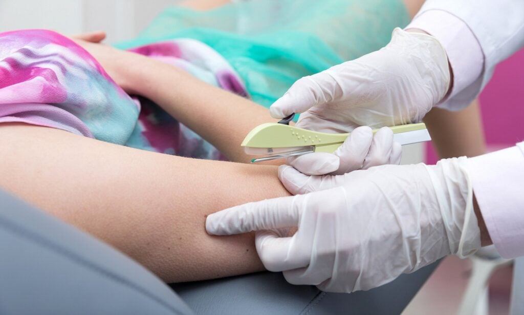 Phương pháp cấy que tránh thai được đánh giá khá an toàn với sức khỏe 