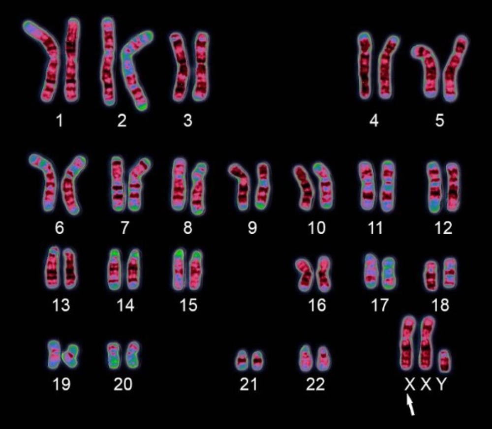 Xét nghiệm sàng lọc NIPT giúp phát hiện các bệnh lý di truyền trong thai kì