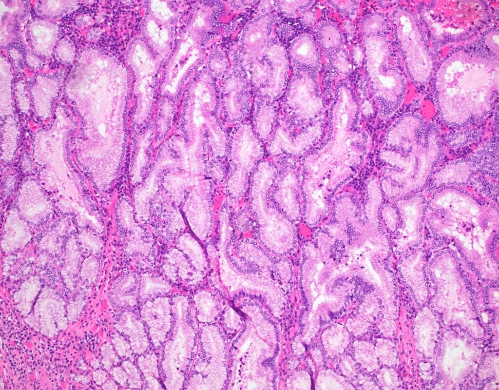 Polyp thể u tuyến thường có kích thước từ 5 - 20mm 