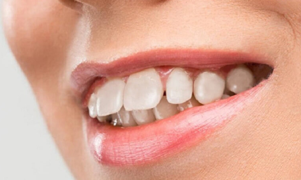 Răng hô là gì? Nguyên nhân, phân loại và cách khắc phục