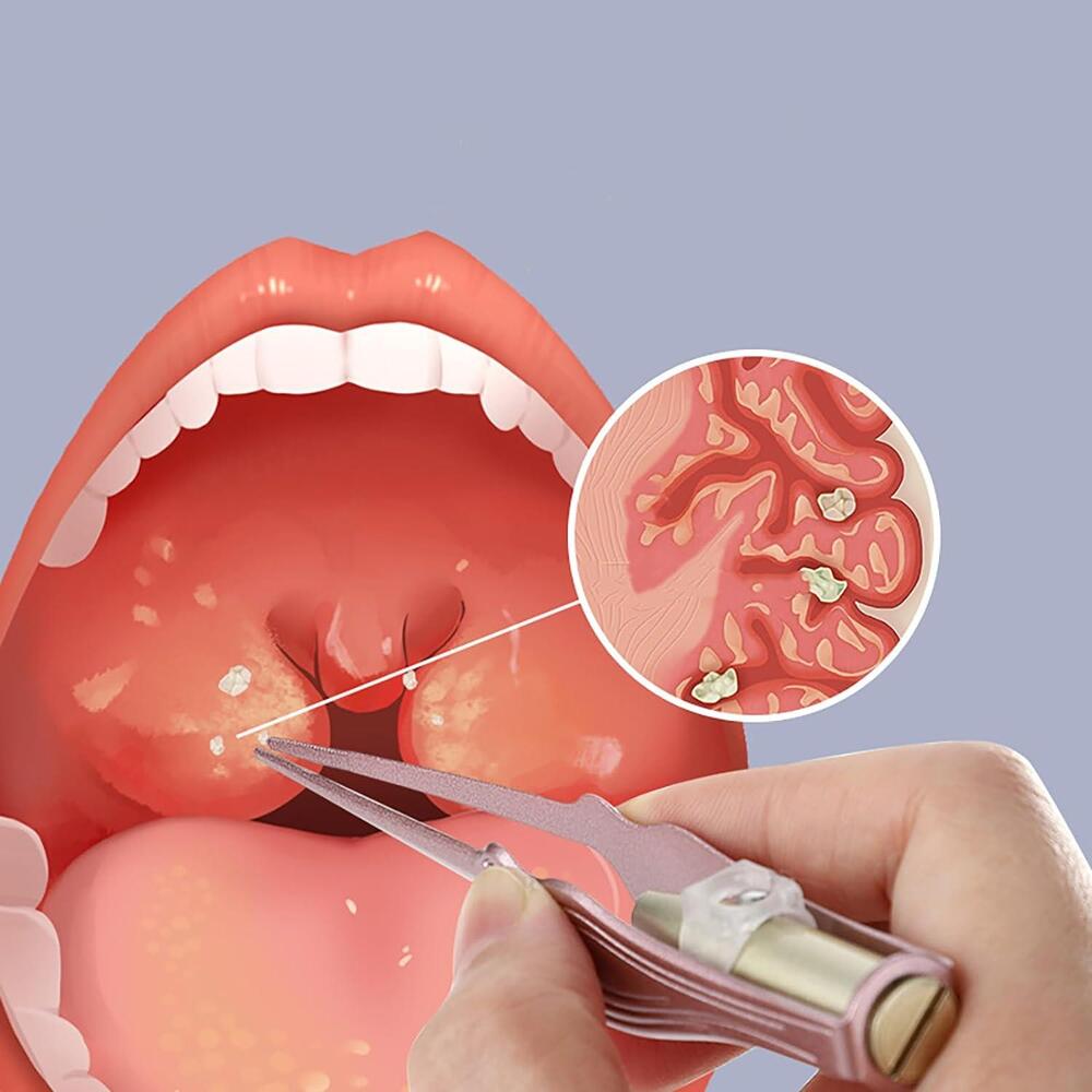 Cách trị sỏi amidan