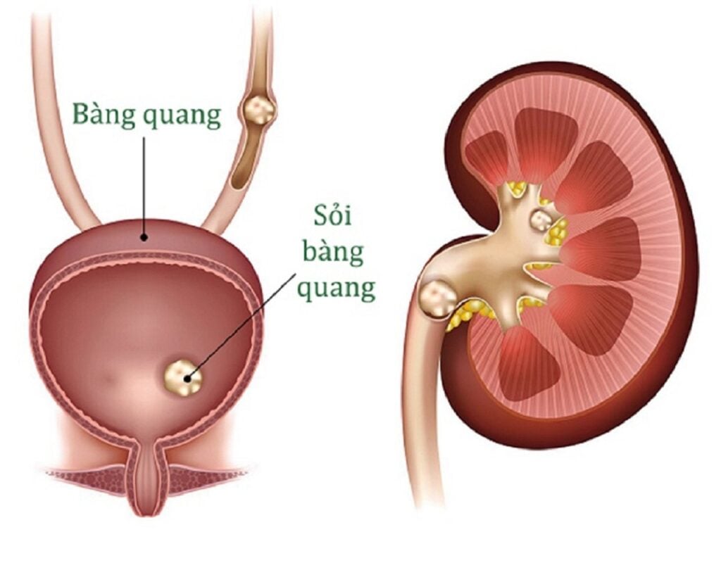 Sỏi bàng quang