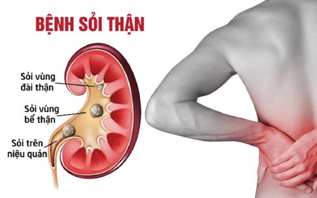 Sỏi thận là gì?