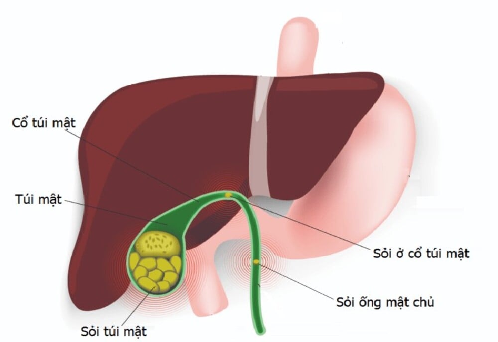 Sỏi túi mật là gì?