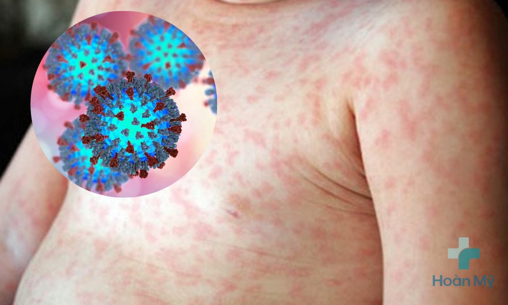Virus sởi gây sốt phát ban 