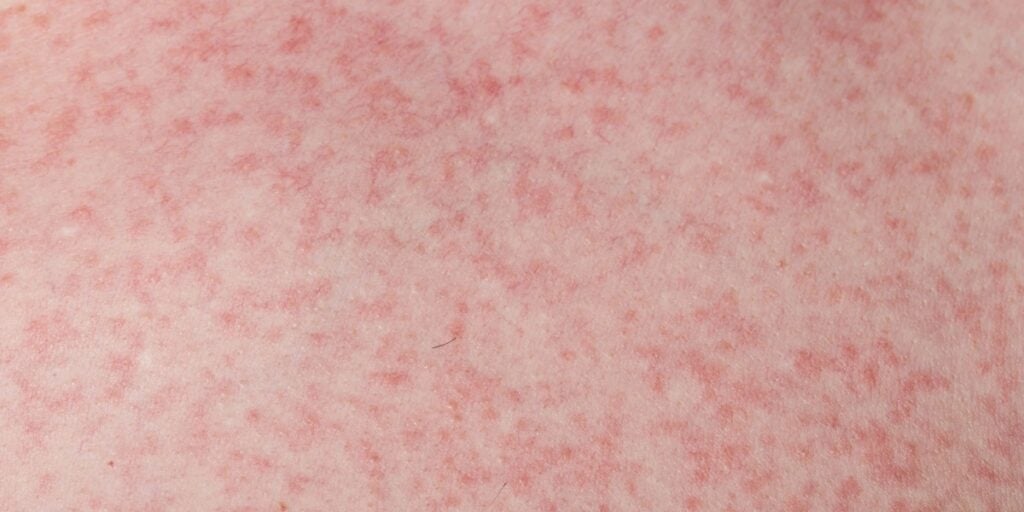 Sốt xuất huyết nổi mẩn đỏ có phải sắp khỏi không?