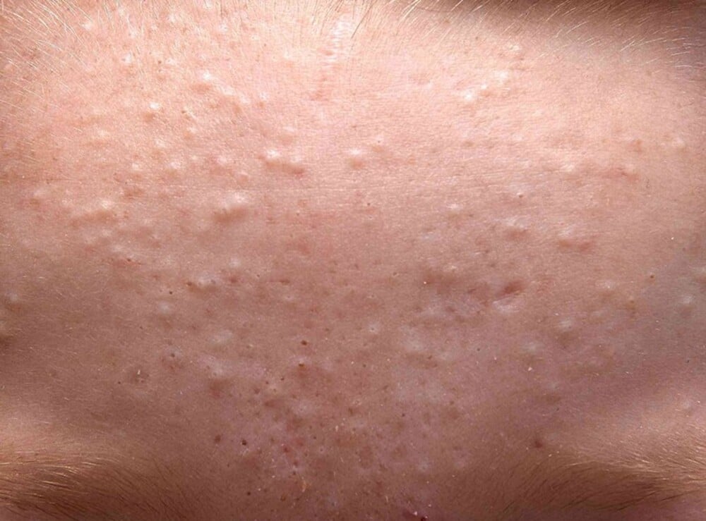 Sử dụng mỹ phẩm kém chất lượng gây nổi mụn