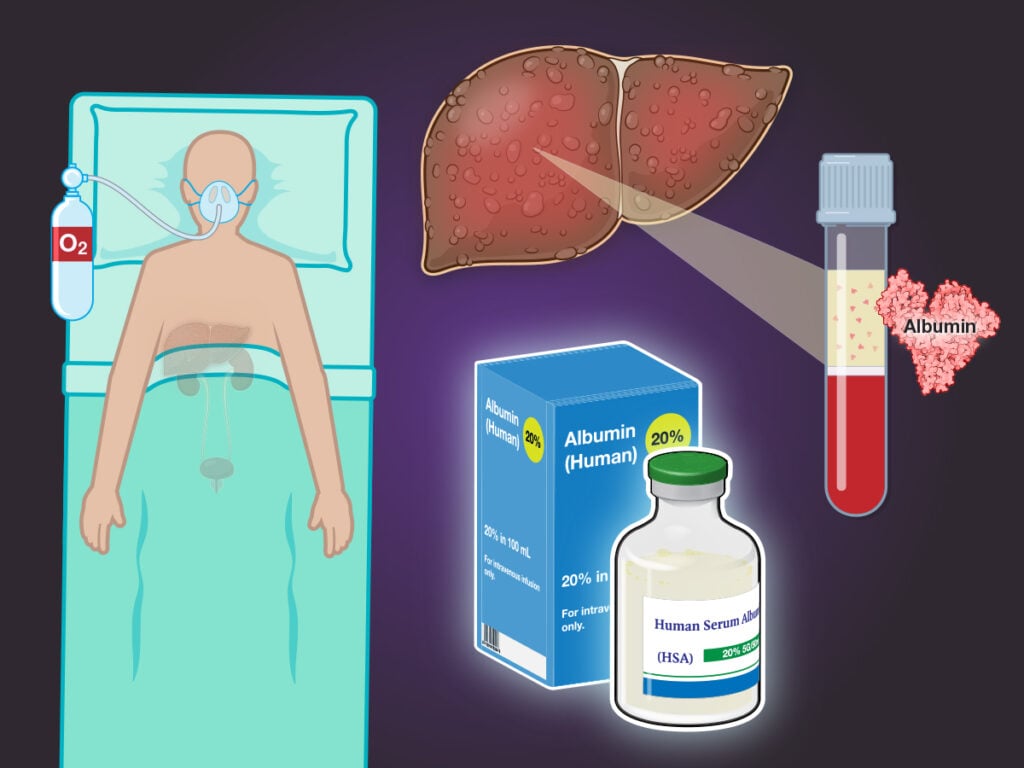 Cần nghiên cứu kỹ trước khi dùng albumin 