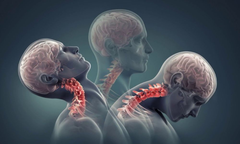 Thoái hóa đốt sống cổ có thể ngăn ngừa và chữa trị