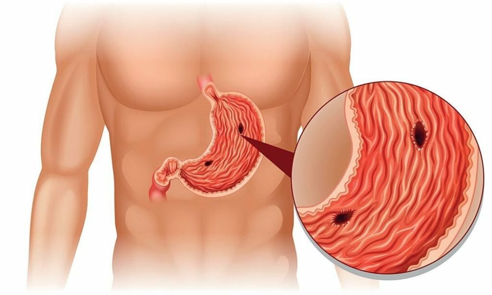 Triamcinolone chống chỉ định với người bị viêm loét dạ dày, phụ nữ có thai, bệnh lao, thủy đậu