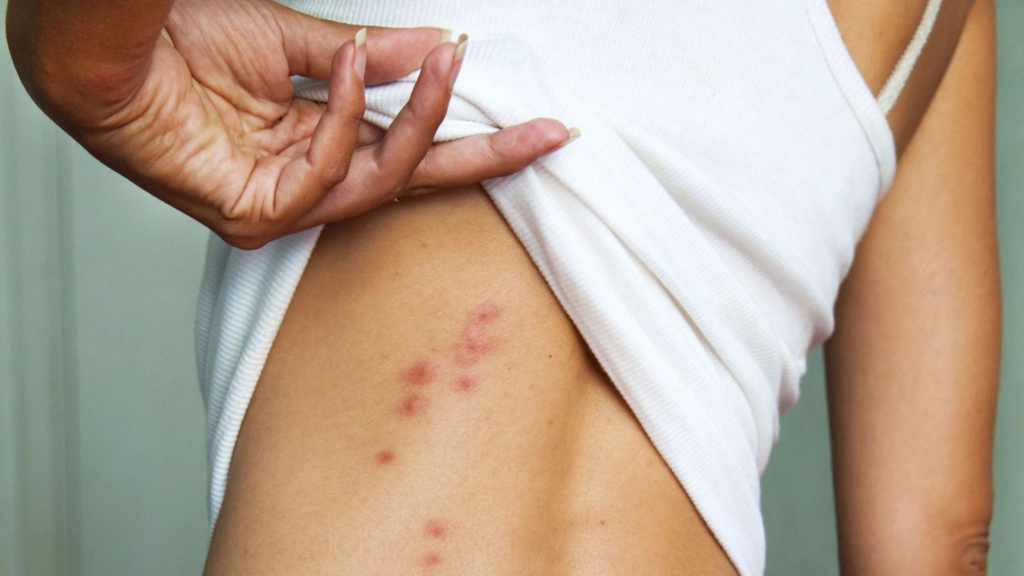 Bệnh thủy đậu ở người lớn có nguy hiểm không? 