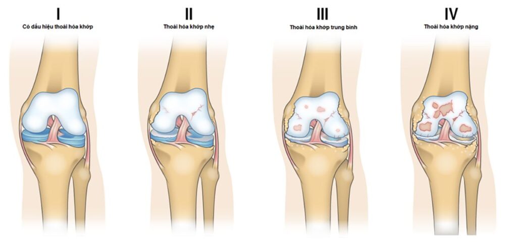 Triệu chứng của bệnh