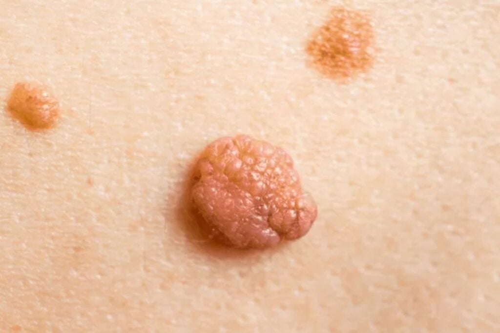 Điều trị xâm lấn giúp loại bỏ hoàn toàn mụn dư nhanh chóng và an toàn 