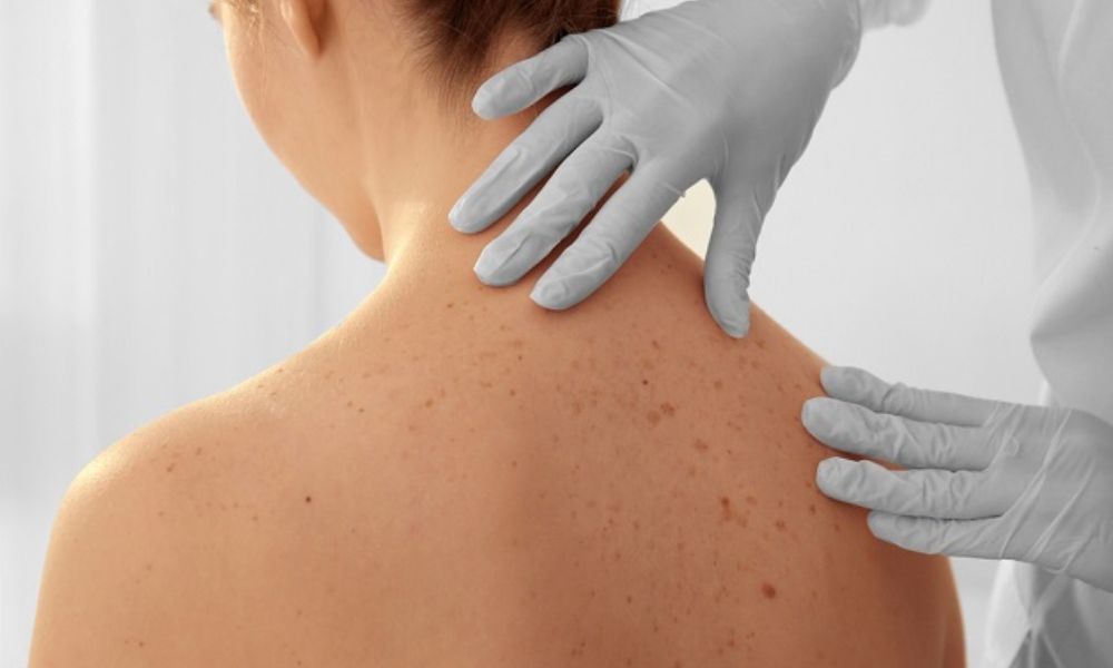 Ung thư da thường phát triển ở vùng da tiếp xúc ánh nắng mặt trời