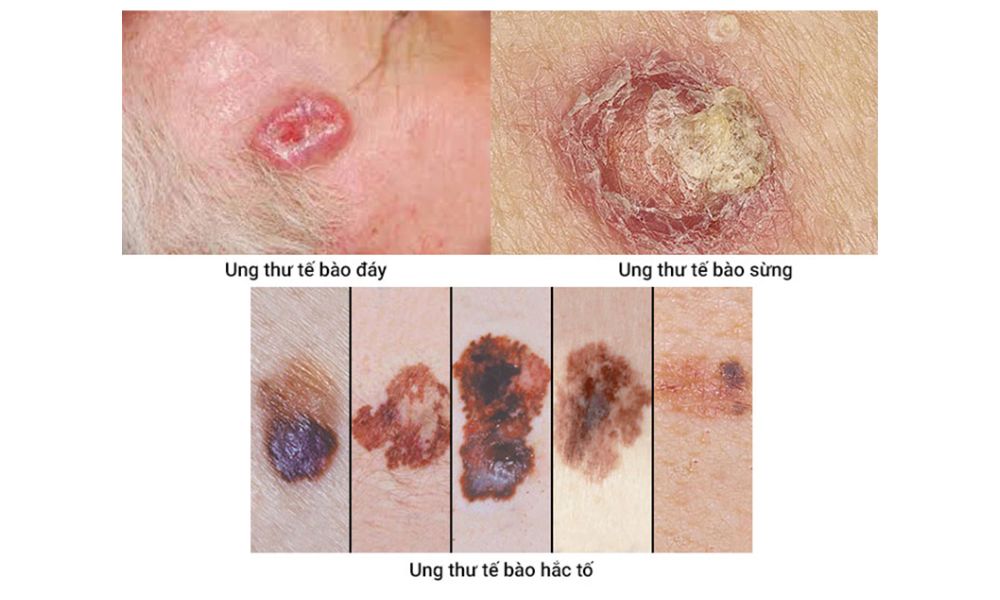 Dấu hiệu nhận biết ung thư da