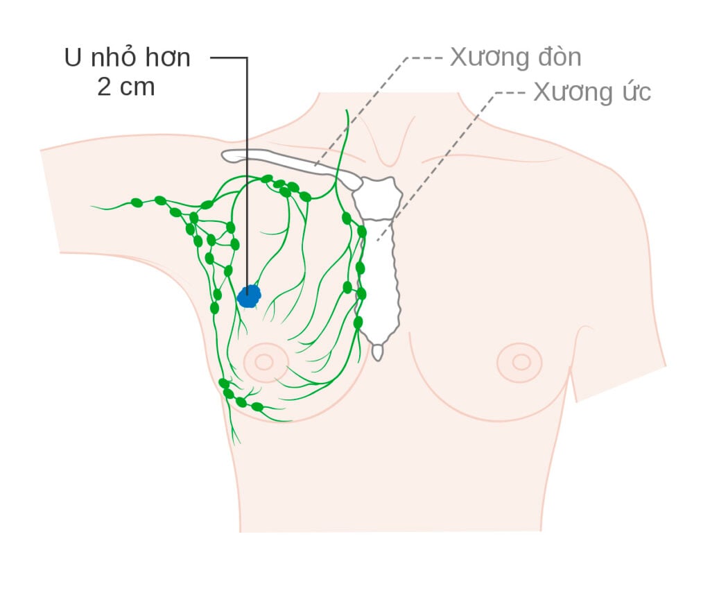 Đa số ung thư vú bắt đầu từ tế bào trong ống tuyến vú, gọi là ung thư vú dạng ống tuyến vú