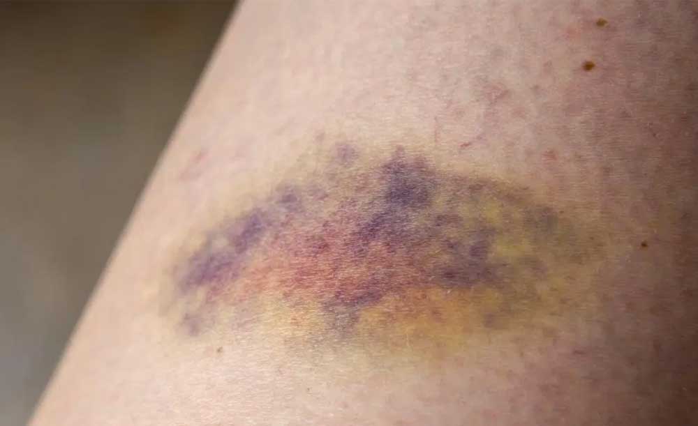 Nguyên nhân xuất hiện vết bầm tím trên da và cách xử lý