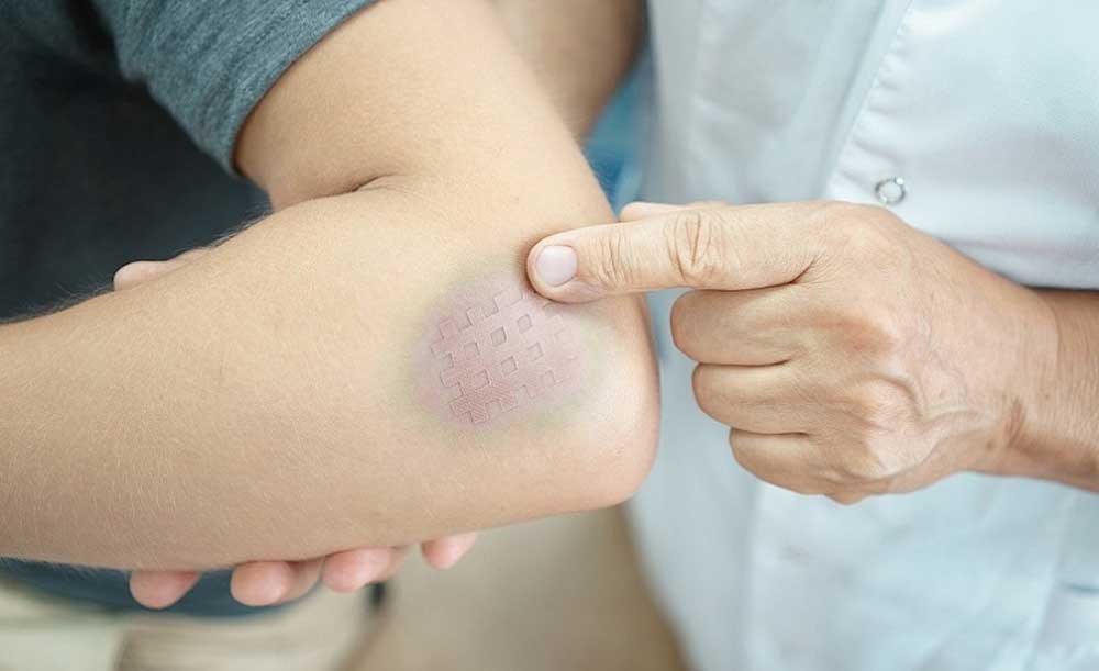 Nguyên nhân xuất hiện vết bầm tím
