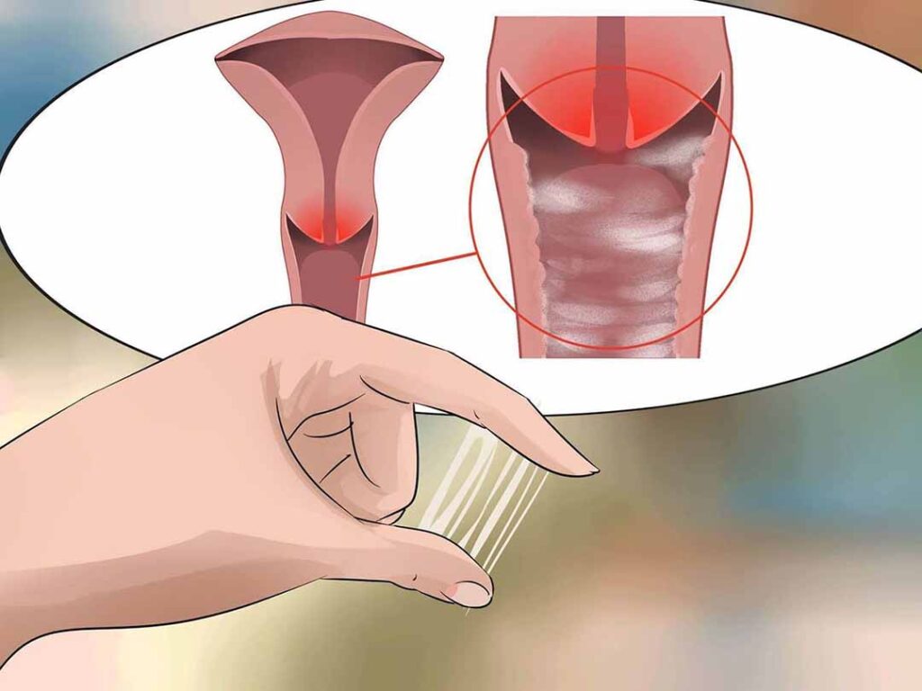 Tìm hiểu viêm âm đạo là gì?