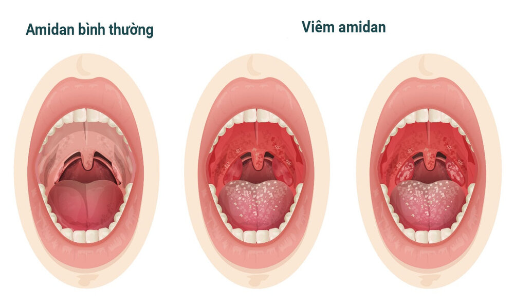 Nguyên nhân hình thành viêm amidan hốc mủ