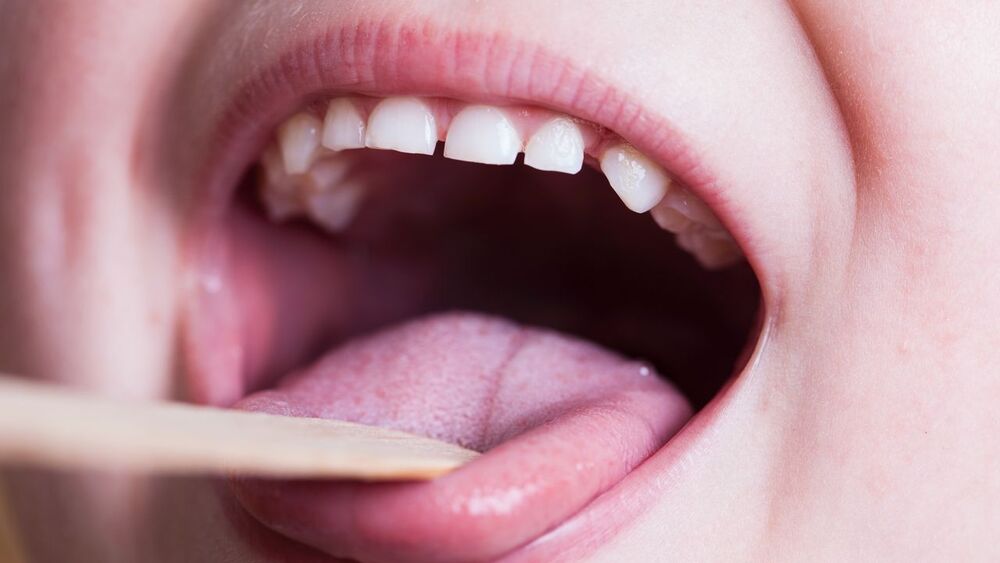 Triệu chứng của viêm họng mãn tính