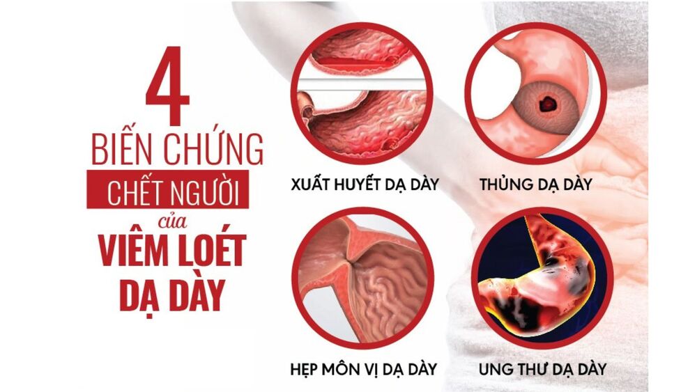 Một số biến chứng nguy hiểm của viêm loét dạ dày