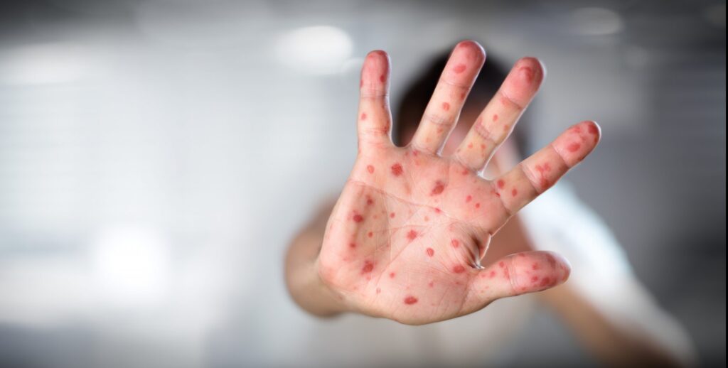 Bệnh viêm mao mạch dị ứng là gì