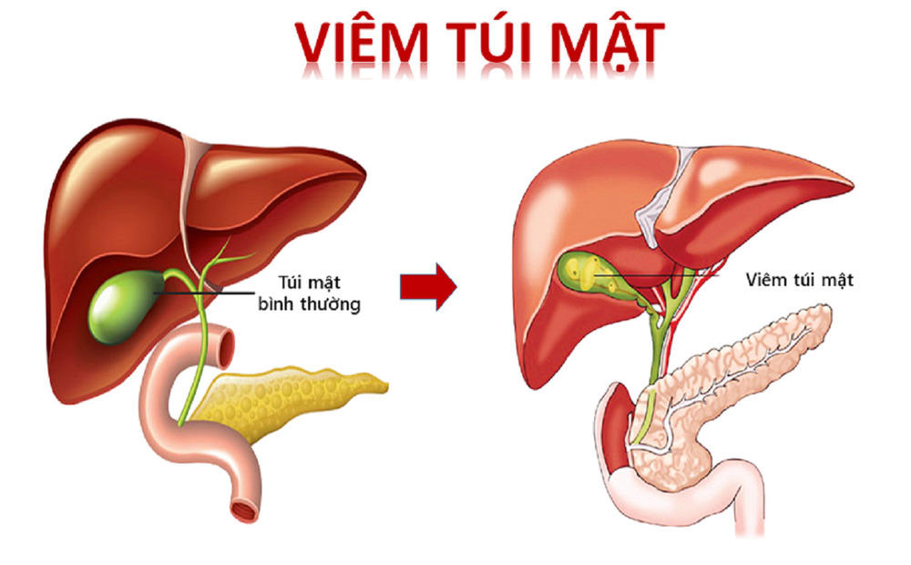 Viêm túi mật và sỏi túi mật là nguyên nhân gây đau vùng bụng bên phải