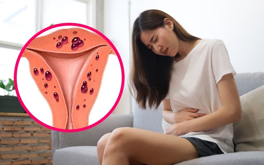 Khí hư bị vón cục, đau bụng dưới âm ỉ là dấu hiệu của viêm vùng chậu 