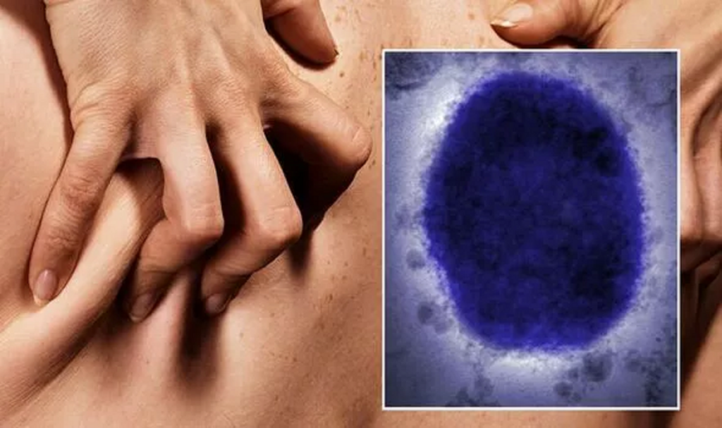 tìm hiểu tiền sử bệnh đậu mùa khỉ