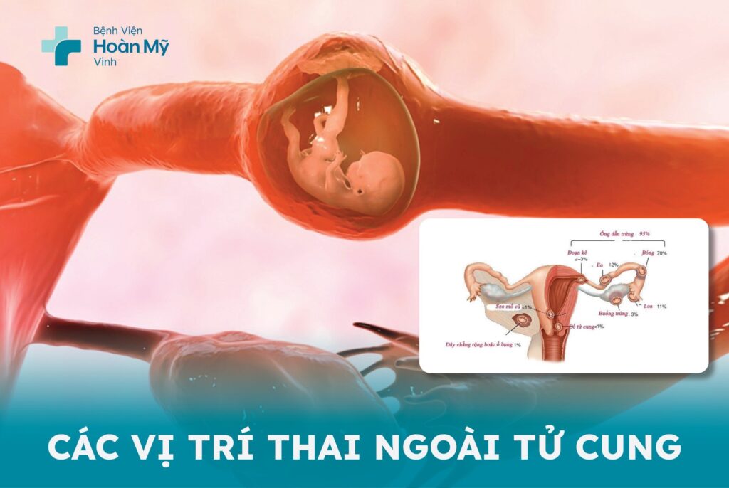 Các vị trí thai ngoài tử cung
