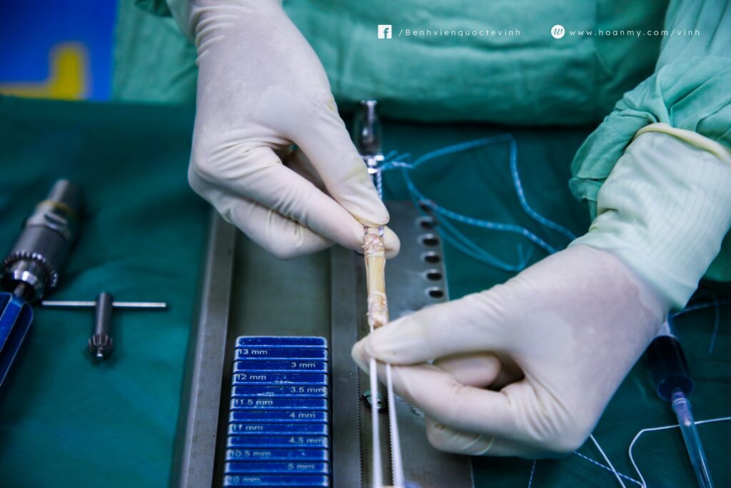 Mảnh ghép dây chằng chéo trước tự thân