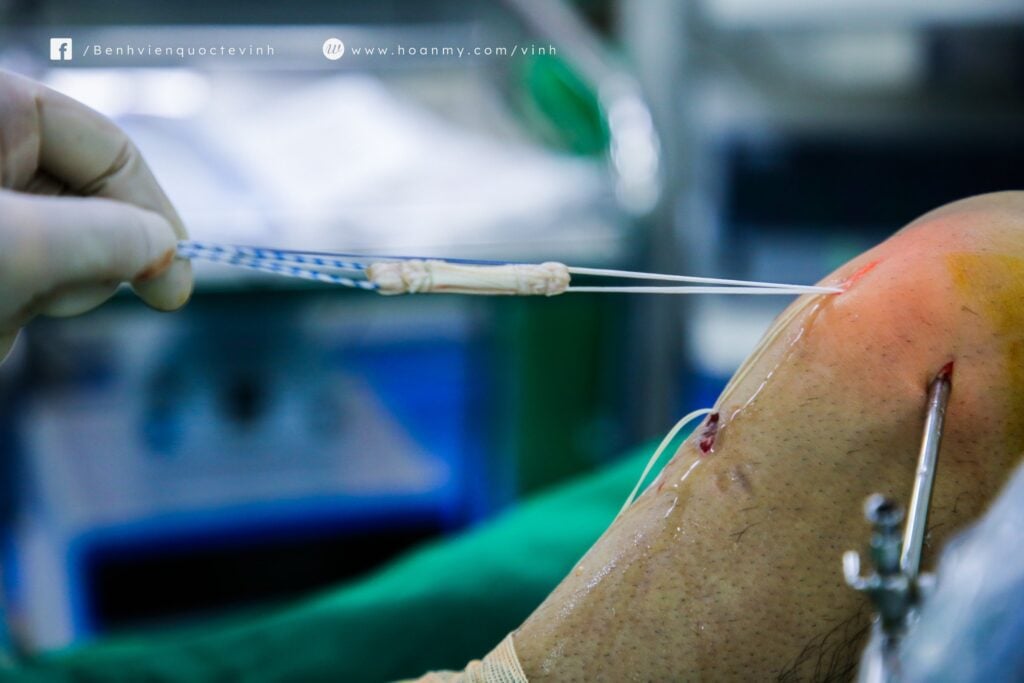 Kéo mảnh ghép vào đường hầm để tái tạo dây chằng mới