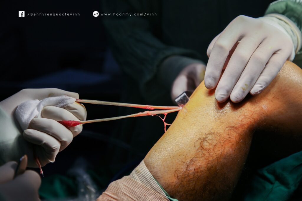 Nội soi tái tạo dây chằng chèo trước cho người bệnh bị chấn thương lâu năm